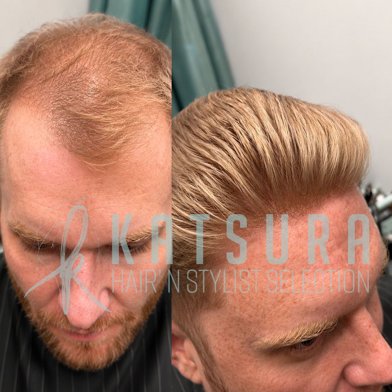 Bruce Complément capillaire 0,06 mm 100% 15 Bruce complément capillaire solution contre la perte de cheveux calvitie postiche homme
