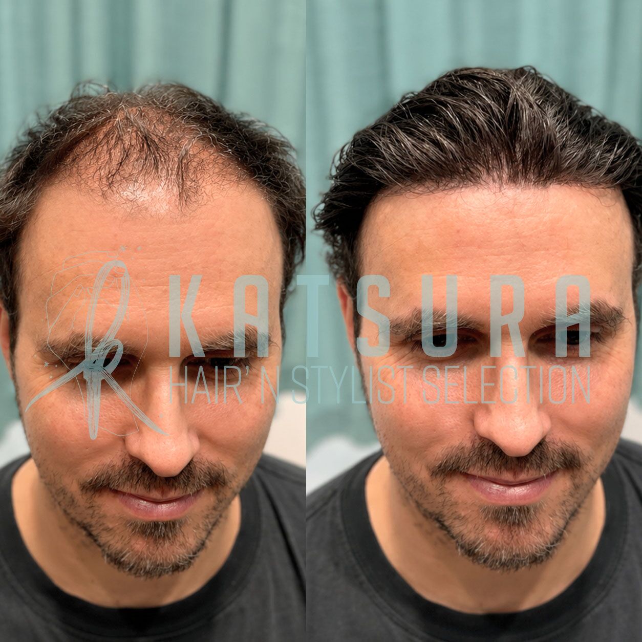 Jackie, complément capillaire 0,03 mm 100% 14 Bruce complément capillaire solution contre la perte de cheveux calvitie postiche homme